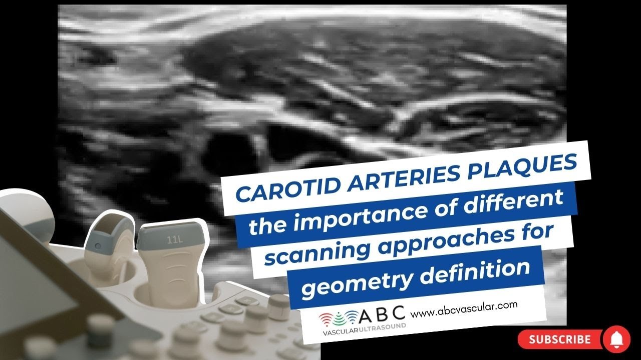 CAROTID ARTERIES PLAQUES: the importance of different scanning approaches for geometry definition