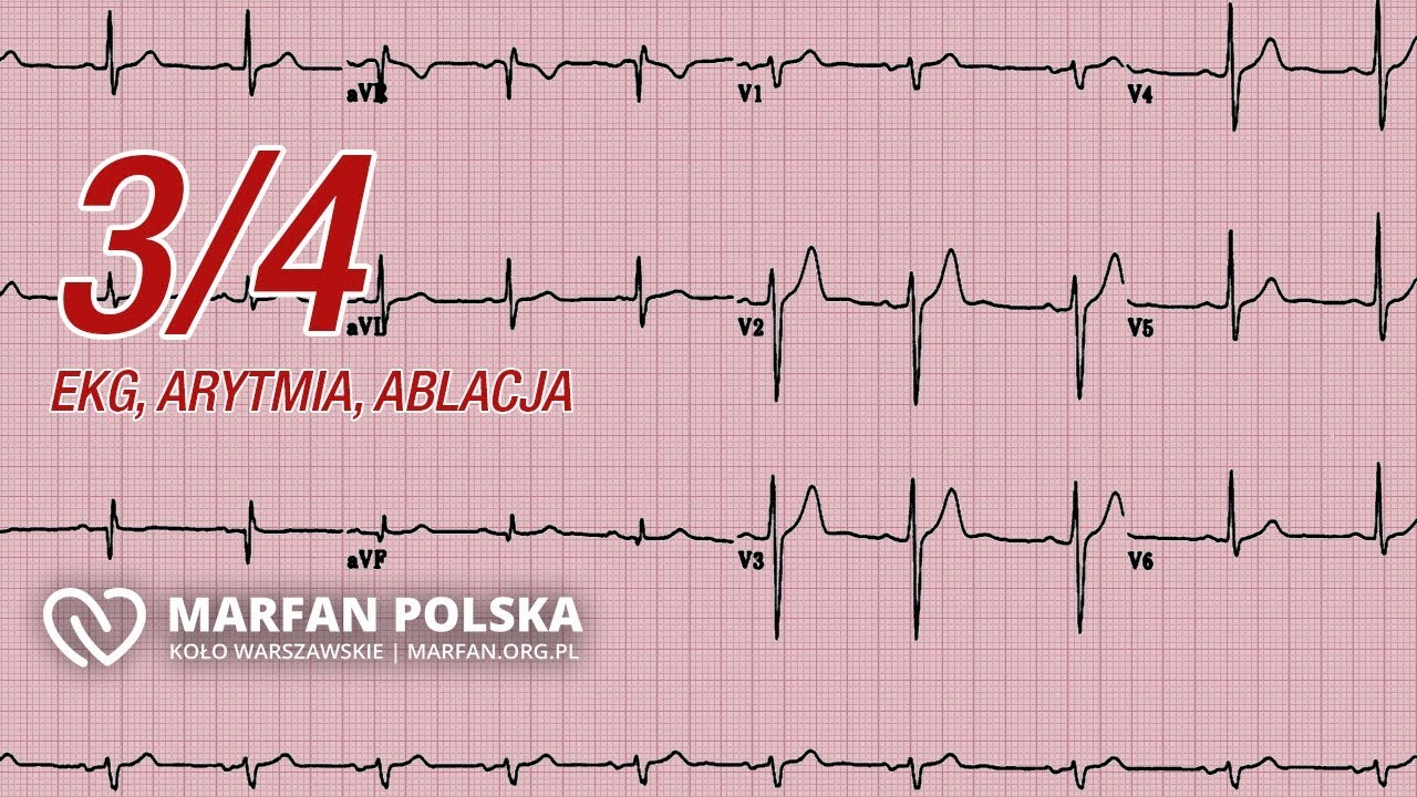 Co to jest ablacja? Jak poradzić sobie z arytmią? Czym jest EKG?