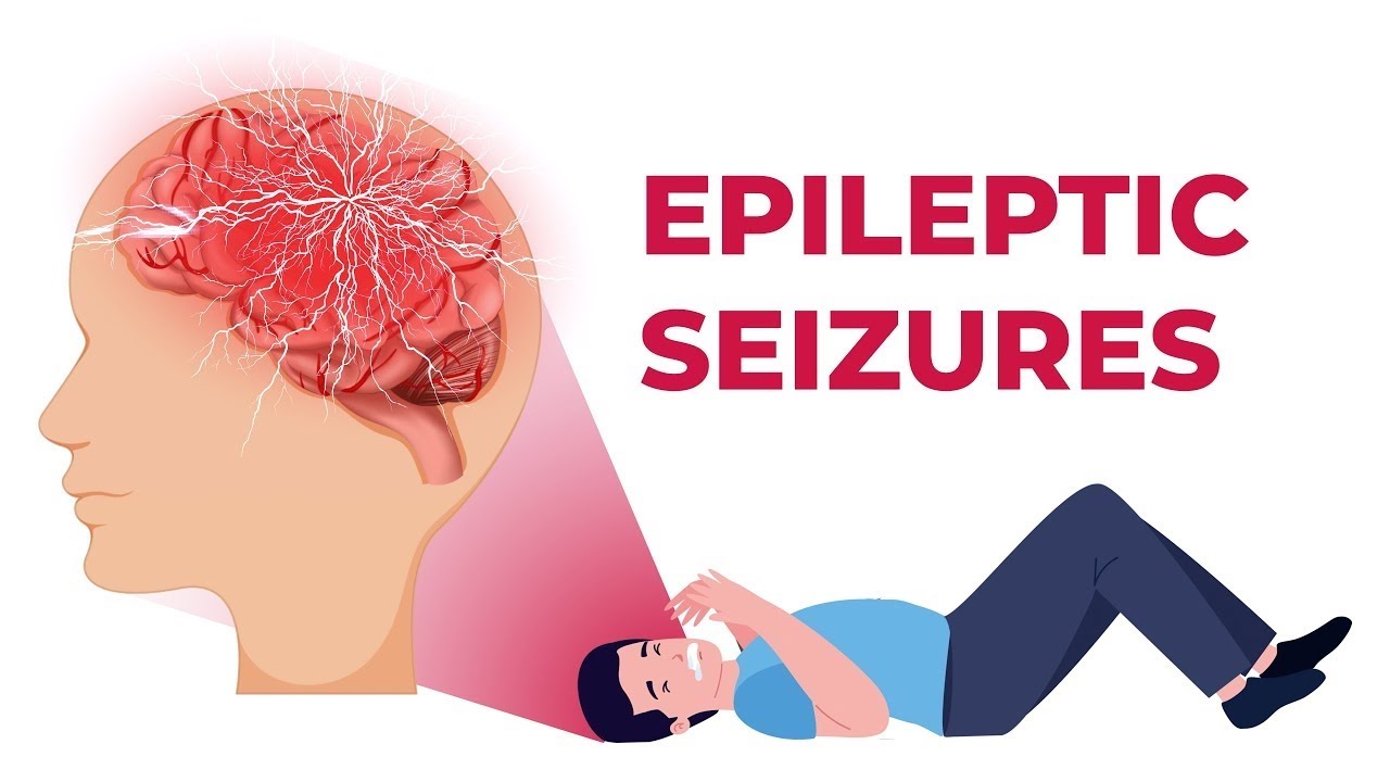 Epilepsy/causes of fits/ Jin ka insan ko chimat Jana?