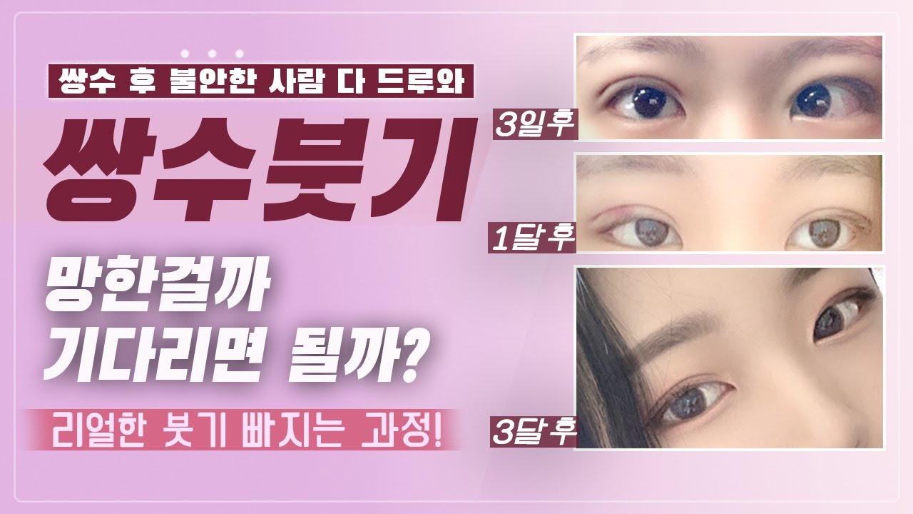 쌍수 후 3주째.. 내눈은 망한걸까 붓기인걸까? 쌍수붓기에 대한 궁금증을 알아봅시다!