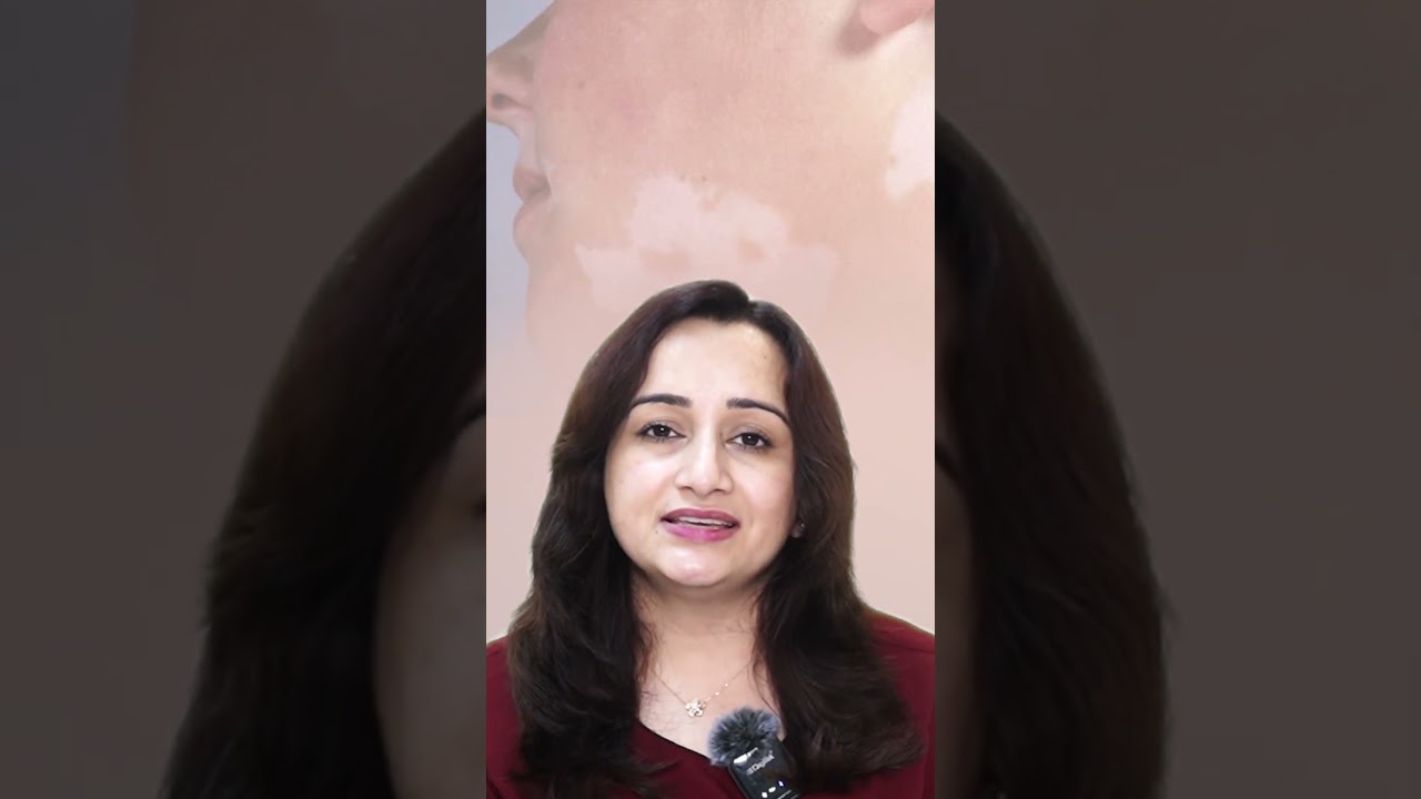 Pityriasis Alba (सफेद दाग) क्या होते है ? | Causes, Symptoms & Treatment