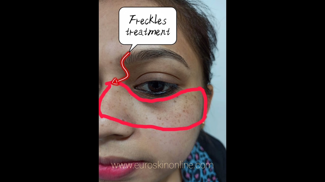 Freckles Removal Treatment