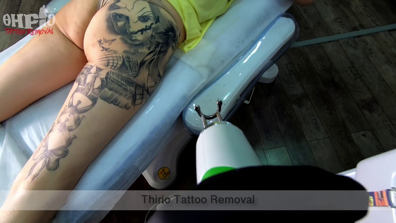 Thirio tattoo removal αφαίρεση τατουάζ σε ένα αρκετά μεγάλο τατουάζ