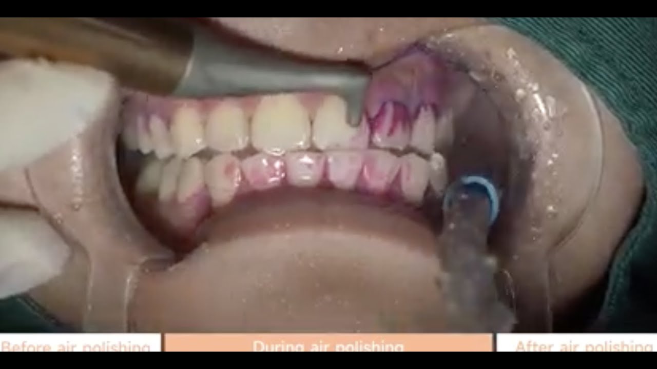 AP A,  Dental Air Polisher In Action!