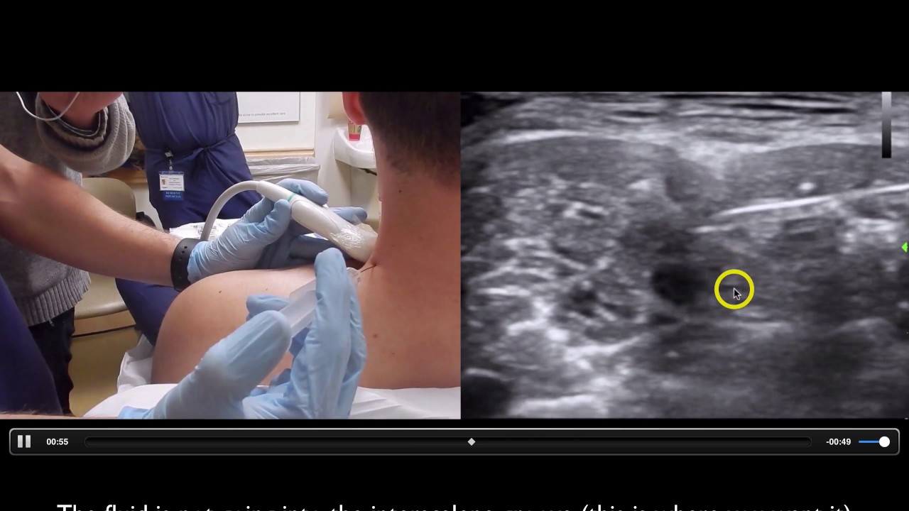 Interscalene Brachial plexus 5minsono PC