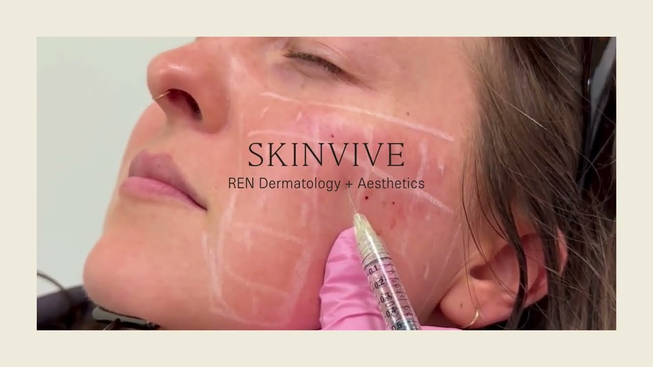 Everything you need to know about Skinvive by Juvederm