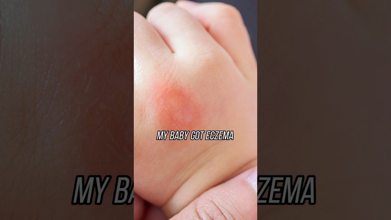 Is your baby's eczema potentially linked to a hidden food allergy? 