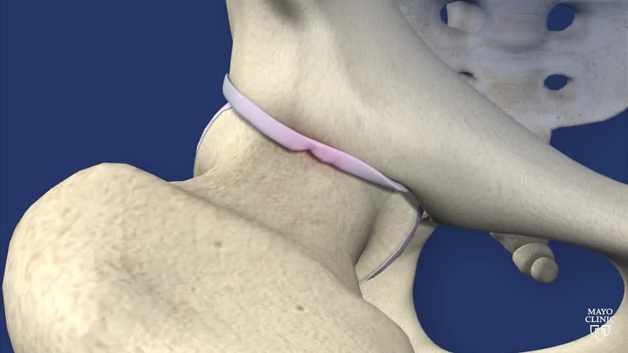 Mayo Clinic Orthopedics and Sports Medicine: Hip impingement