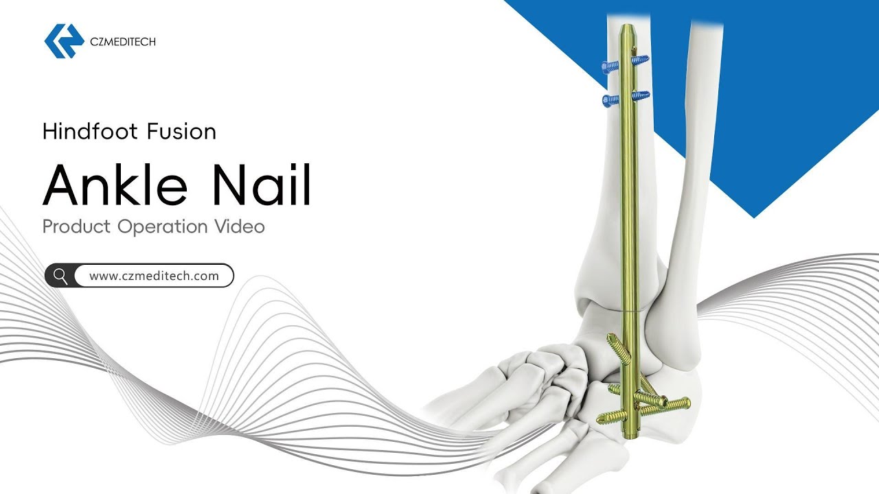 Hindfoot Fusion Ankle Nail | Surgical Technique & Product Operation Video