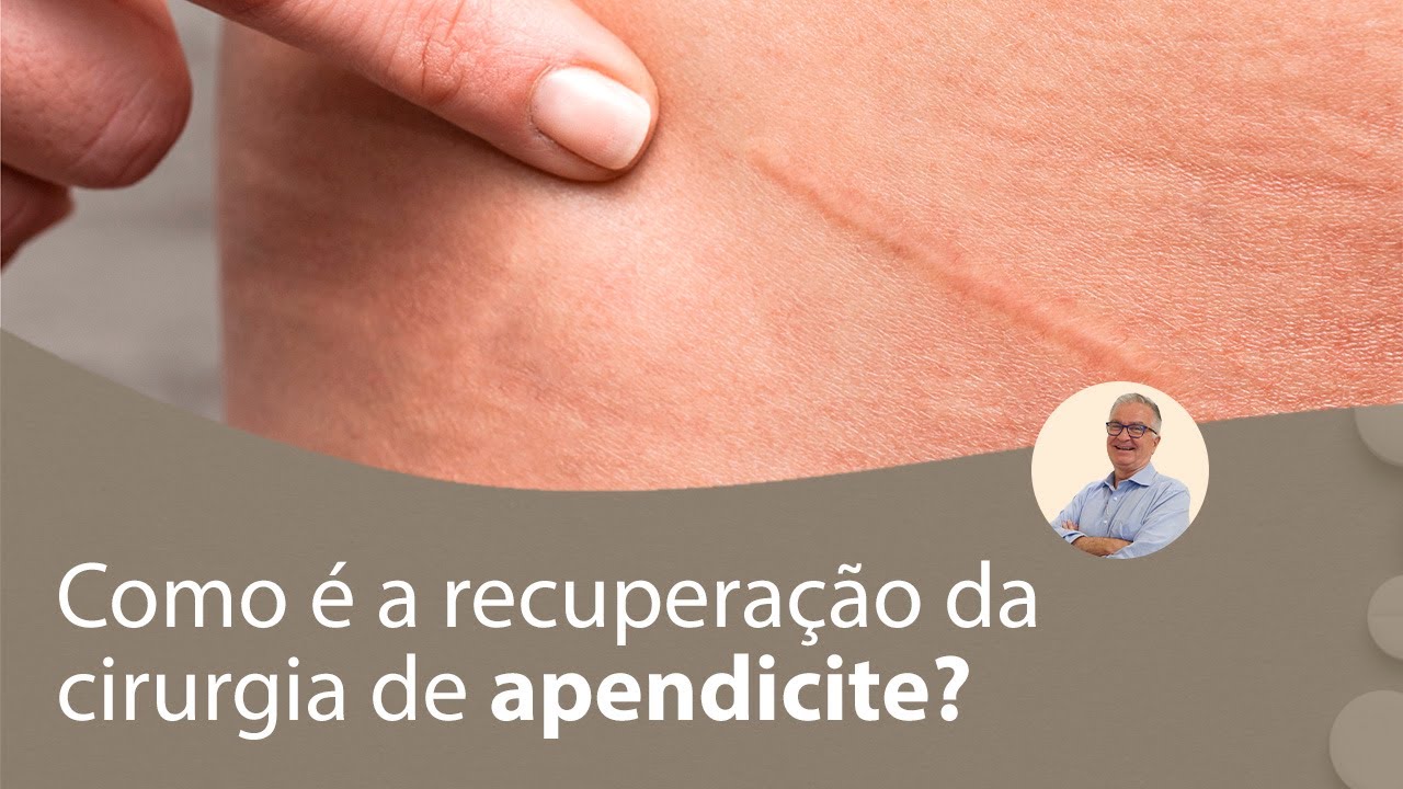Como &eacute; a recupera&ccedil;&atilde;o da cirurgia de apendicite? | Prof. Dr. Luiz Carneiro CRM 22761