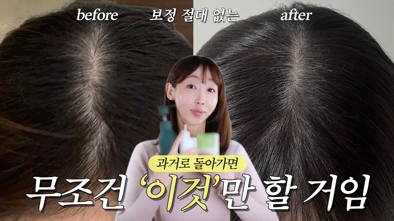 의사도 모르는 정수리, M자 탈모 극복 후기❗직접 해본 것들 중에서 찐으로 효과 본 것들만 풀어봄💯