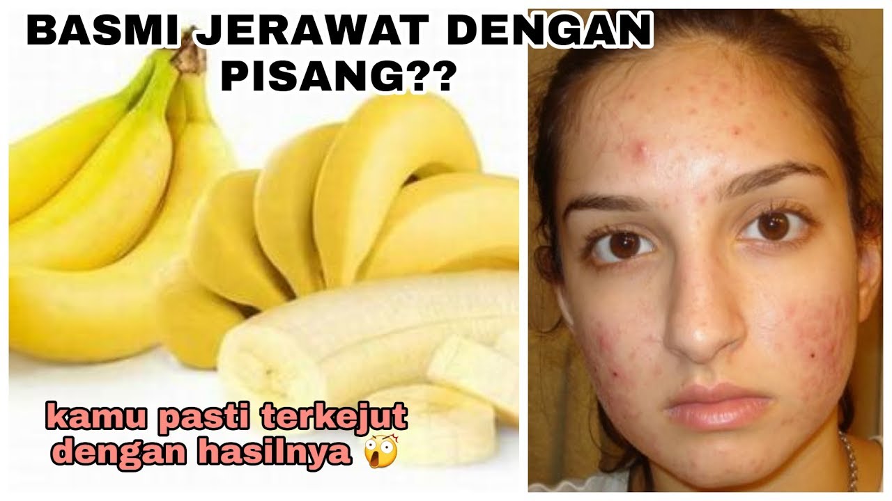 BASMI JERAWAT DENGAN PISANG || MURAH DAN AMPUH BANGET
