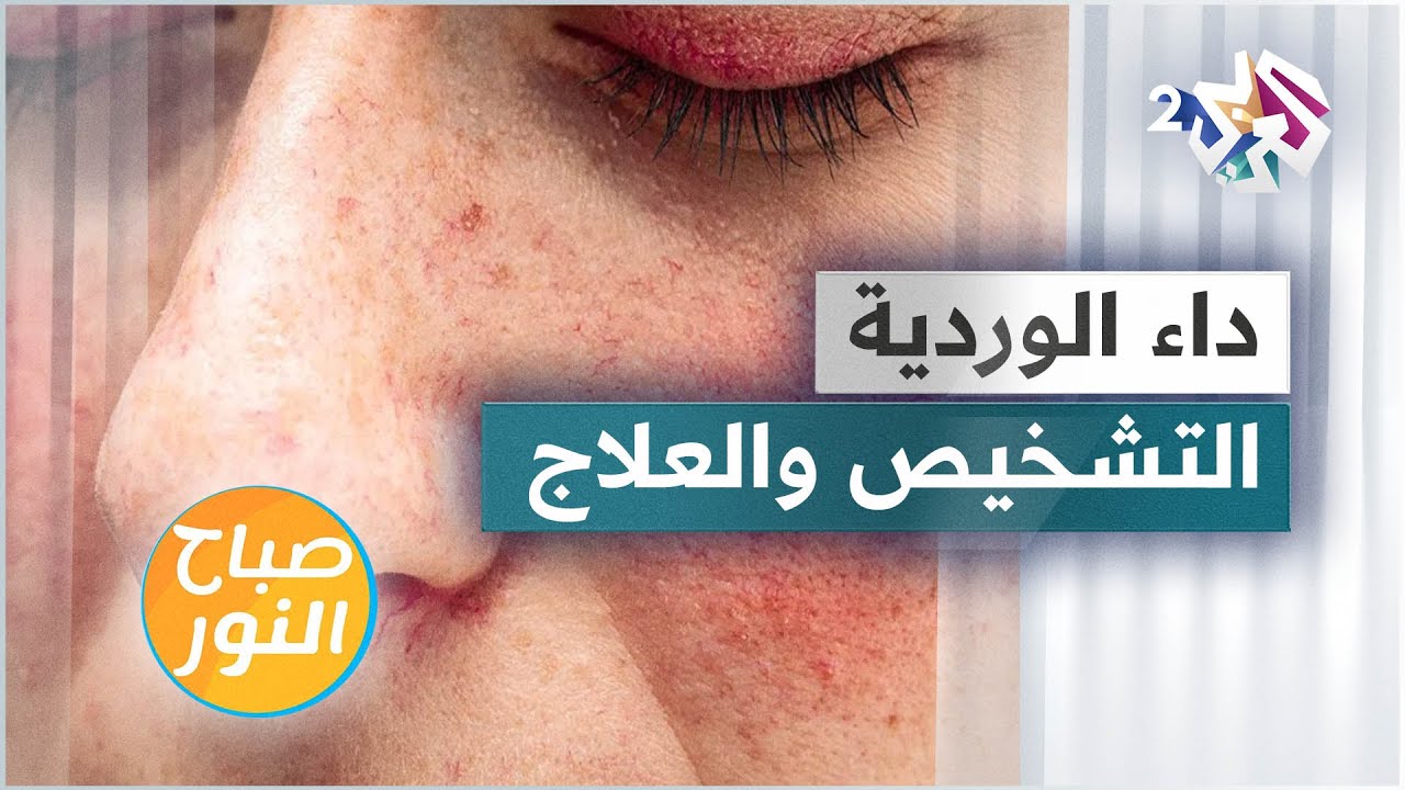 داء الوردية .. الأعراض والتشخيص وطرق العلاج
