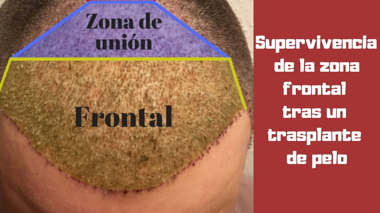 Supervivencia de folículos en la zona frontal tras un trasplante de pelo