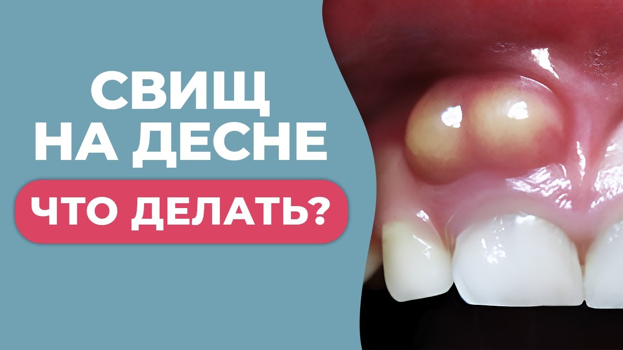 ЧЕМ ОПАСНА ШИШКА НА ДЕСНЕ И КАК БЫСТРО ОТ НЕЕ ИЗБАВИТЬСЯ?