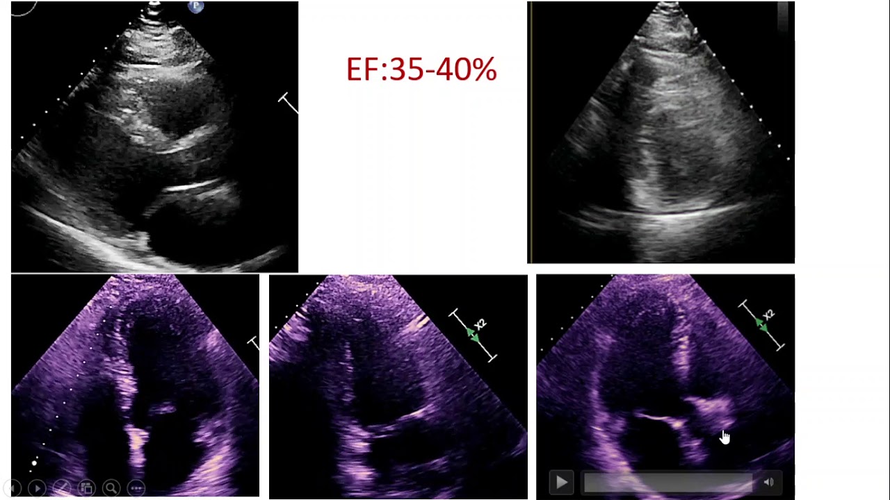 visual estimating LV Ejection Fraction