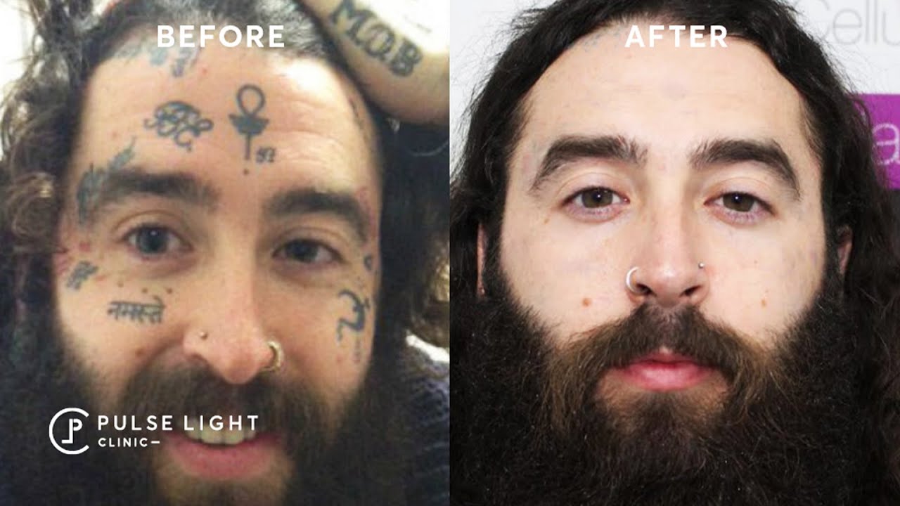 Лазерное удаление татуировок — все, что вам нужно знать об этом