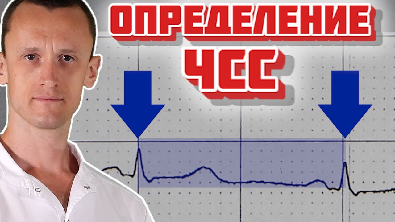 Определение ЧСС на ЭКГ | Пульс