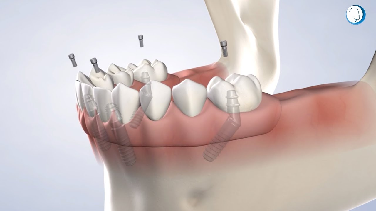 Full-Arch Restoration at Roden Oral, Facial, and Dental Implant Surgery, Birmingham, AL