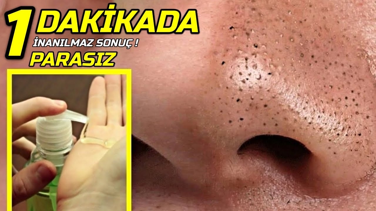 Evinizdeki Sıvı Sabuna Bunları Koyun 1 DAKİKADA SİYAH NOKTALARINIZDAN KURTULUN ! │ Güzellik Bakım