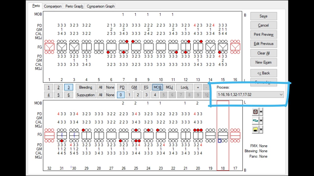 Complete Full Mouth Perio Charting