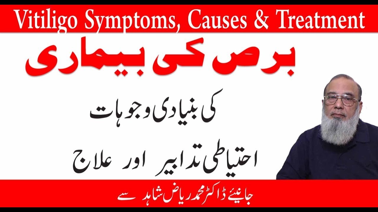 Vitiligo Symptoms,Causes And Treatment | Vitiligo Treatment | Bars Ki Bimari Ka ilaj
