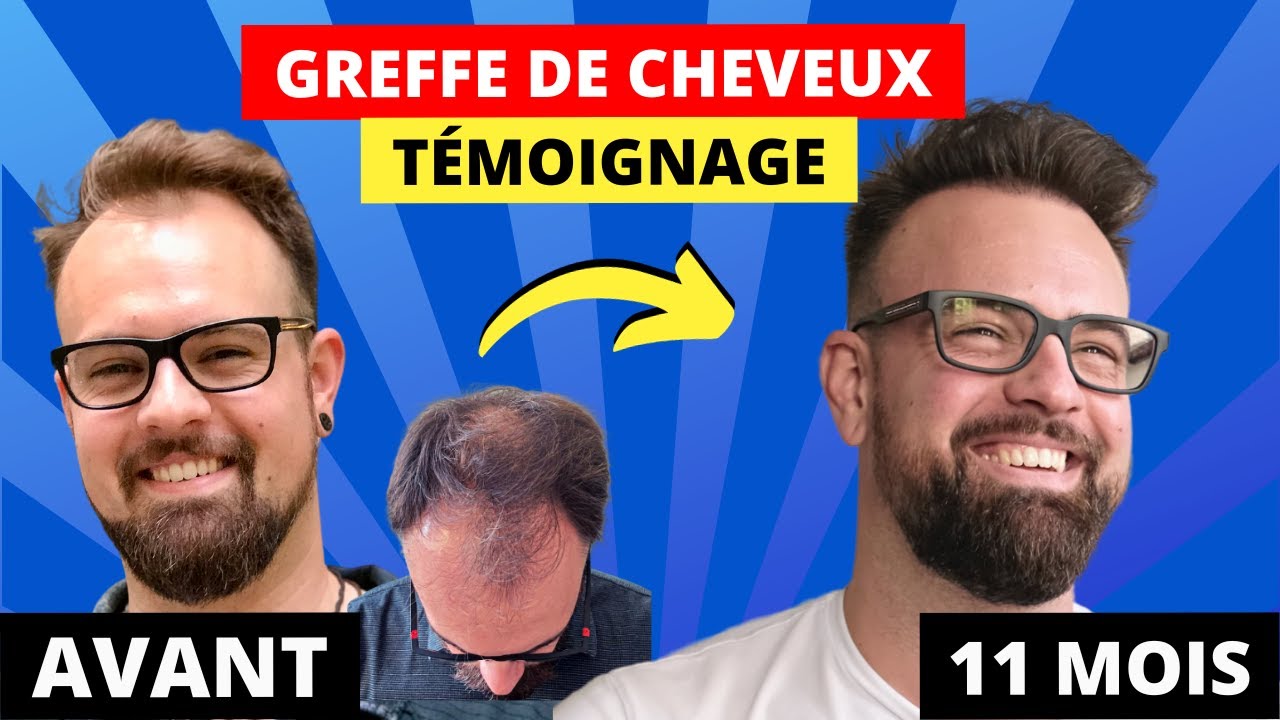 Transformation Greffe de Cheveux : Matthieu témoigne 11 mois après sa greffe en Grèce