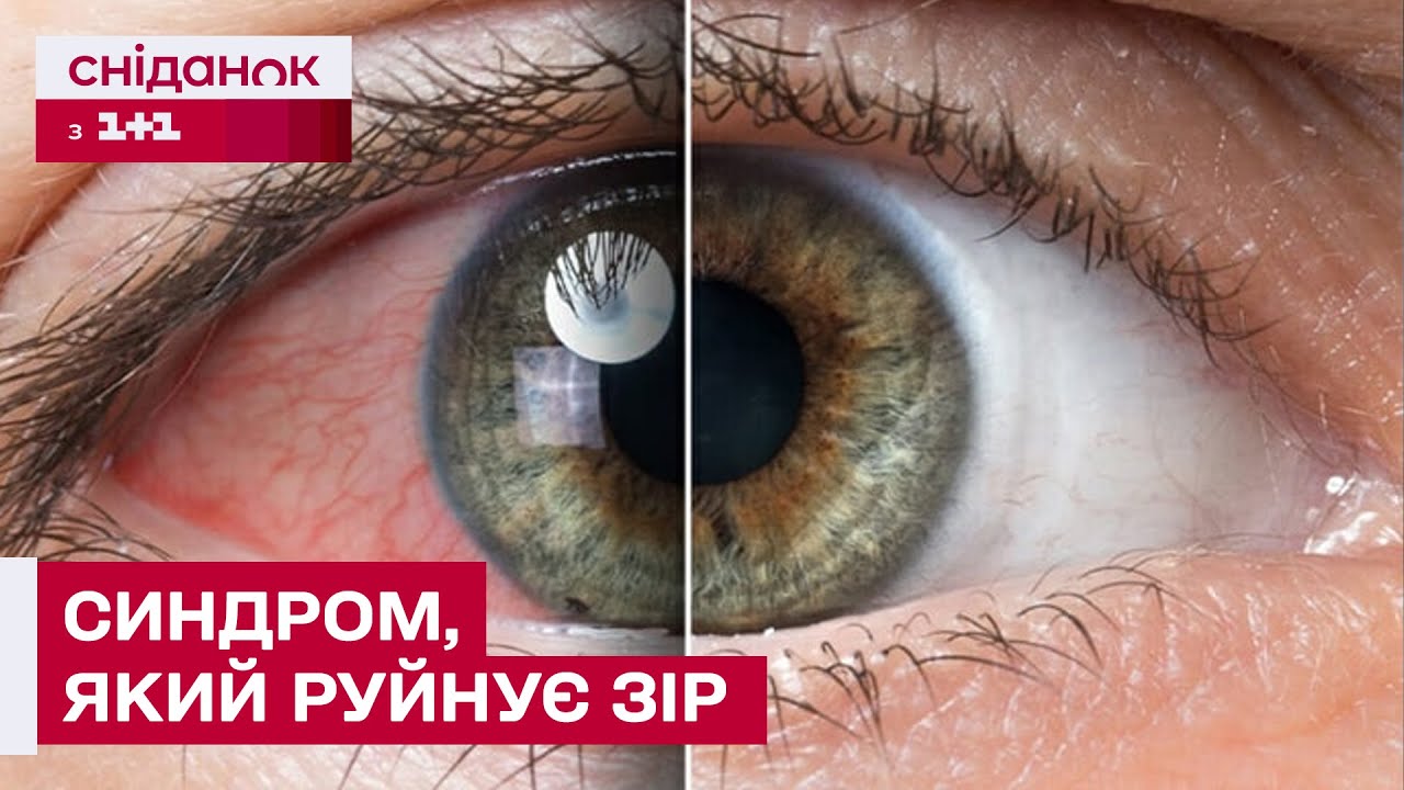 НЕ ІГНОРУЙ ЦЮ ПРОБЛЕМУ! Сухе око може призвести до ВТРАТИ ЗОРУ! Як з цим боротися?