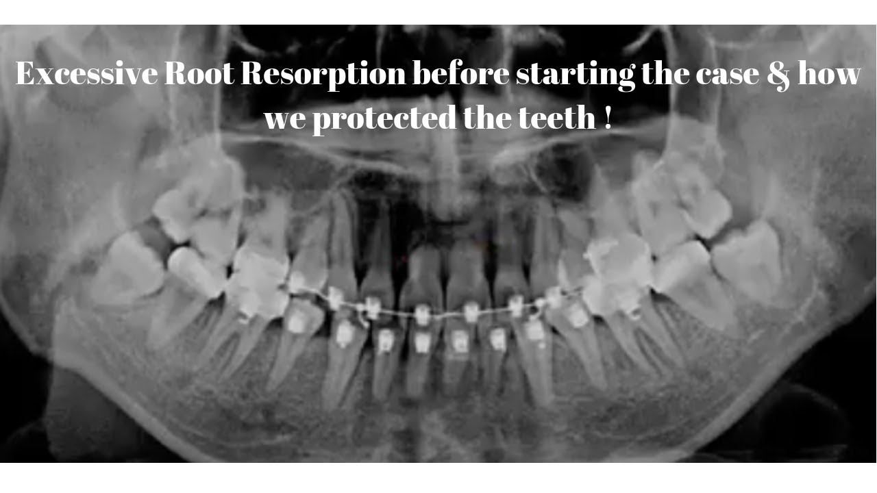 Excessive Root Resorption before starting the case  & how we protected the teeth !