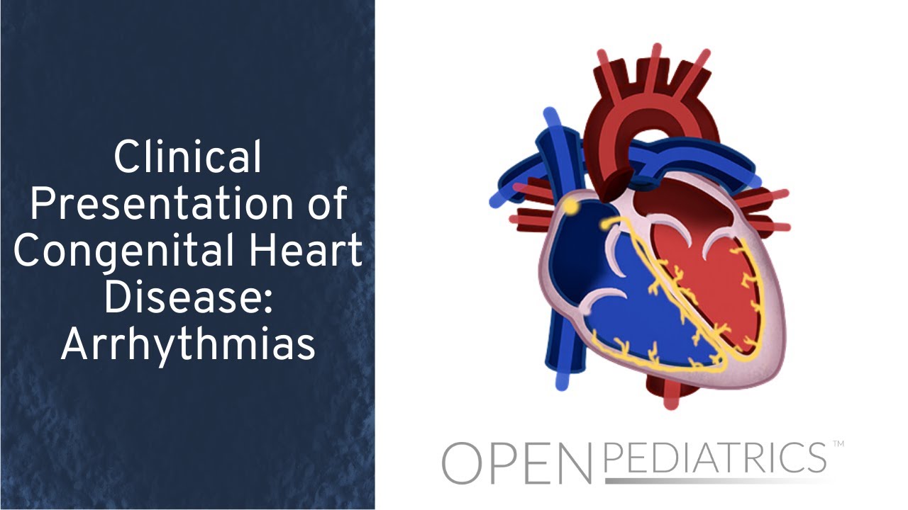 Arrhythmias by M. Freed, I. Baiu, L. DelSignore | OPENPediatrics