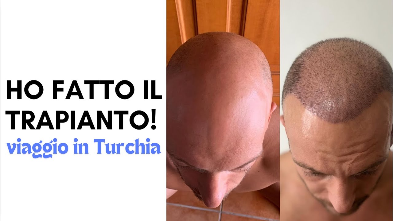 IN TURCHIA PER IL TRAPIANTO DI CAPELLI! La Mia Esperienza Reale | Tutto Quello Che c'è da Sapere