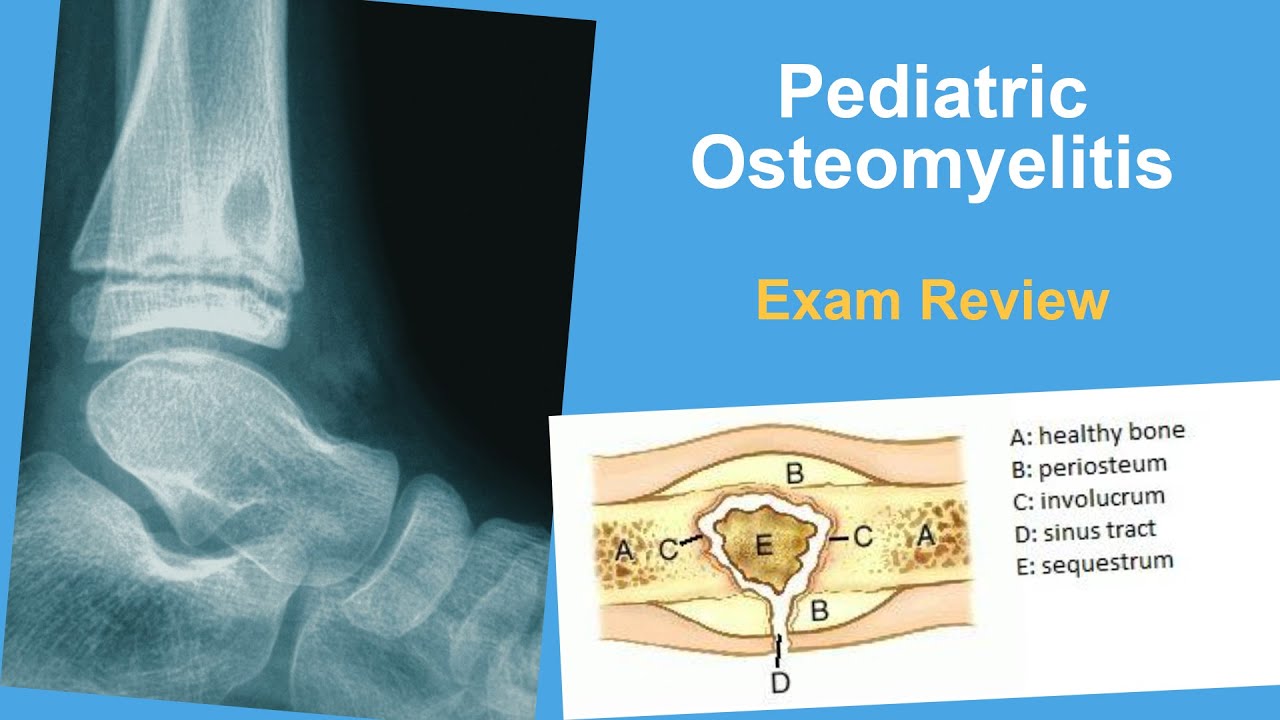 Pediatric Osteomyelitis Exam Review - Lindsay Andras, MD