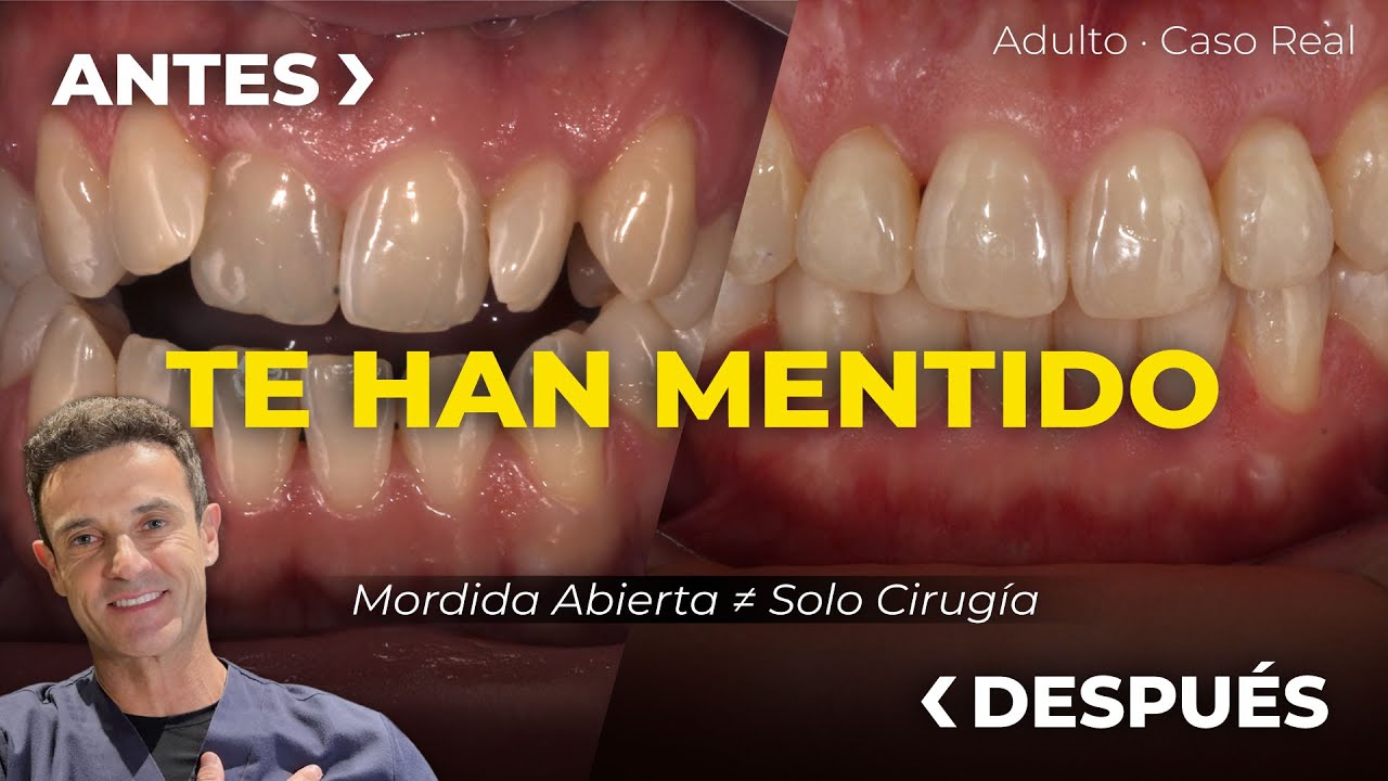 Mordida Abierta en Adultos: Te Han Mentido, No Siempre Necesitas Cirugía  - Clínica Peydro Herrero