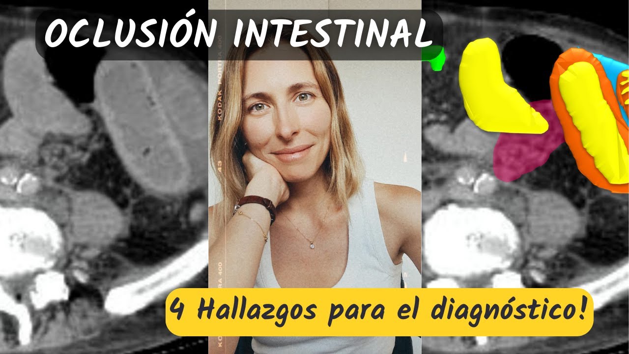 Oclusión intestinal 😳 ¡4 Hallazgos tomográficos para hacer el diagnóstico!
