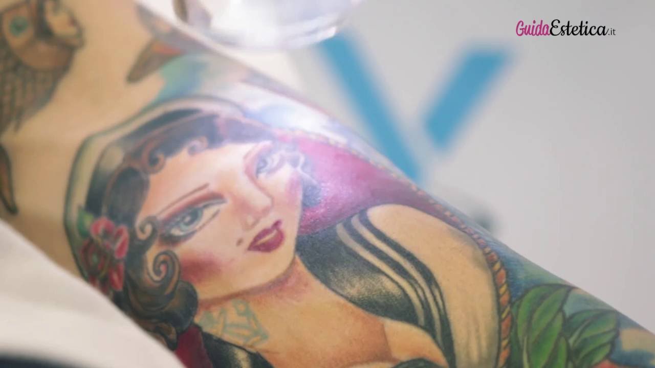 Centro Laser dott. Laspina - Rimozione tatuaggi