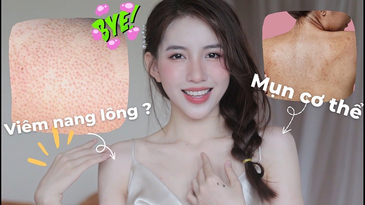 CÁCH DƯỠNG DA BODY LÁNG MỊN | Chấm dứt Viêm Nang Lông - Mụn Cơ Thể để lấy lại sự tự tin ! Mai Trinh