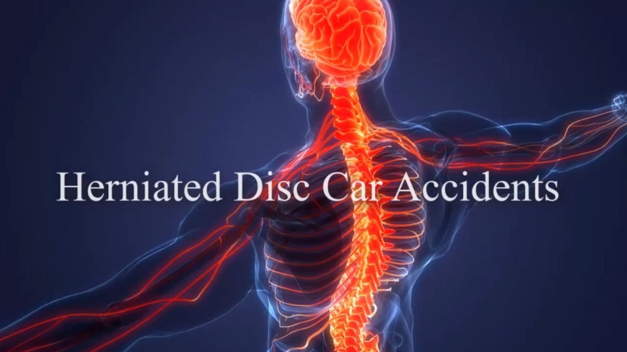 Herniated Disc Car Accidents: Spinal Injuries and Highway Accident Attorney in Southern California