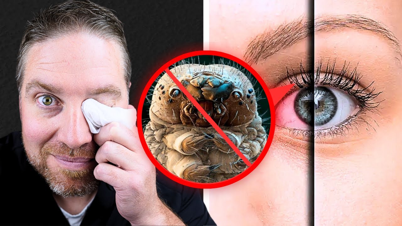 Best Eyelid Wipes To Get Rid Of Eyelid Mites!