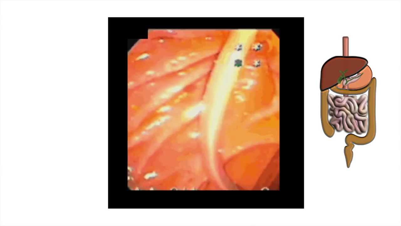 Biliary ascariasis