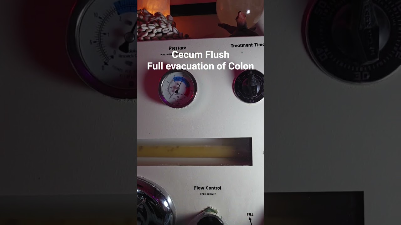 Cecum Flush - Full evacuation of Colon