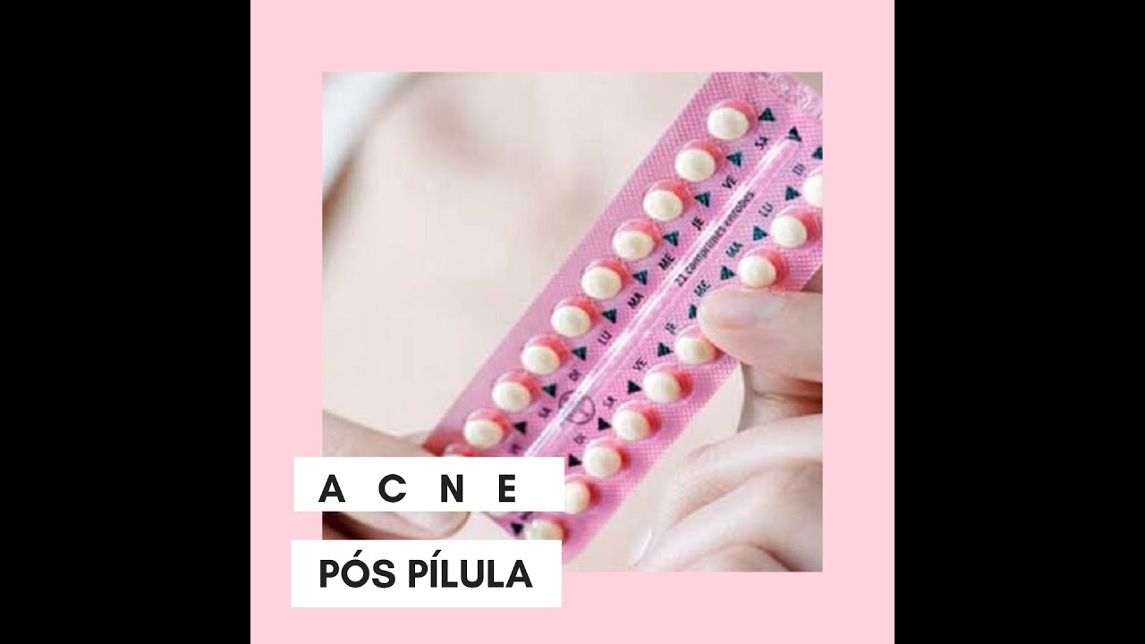 ACNE Após Parar Anticoncepcional ? Entenda e aprenda dicas naturais de tratamento