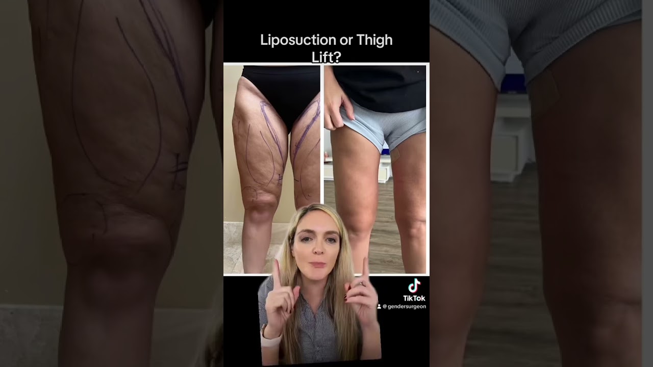 Lipo or Thigh Lift? #plasticsurgeon #thighfat #liposuction
