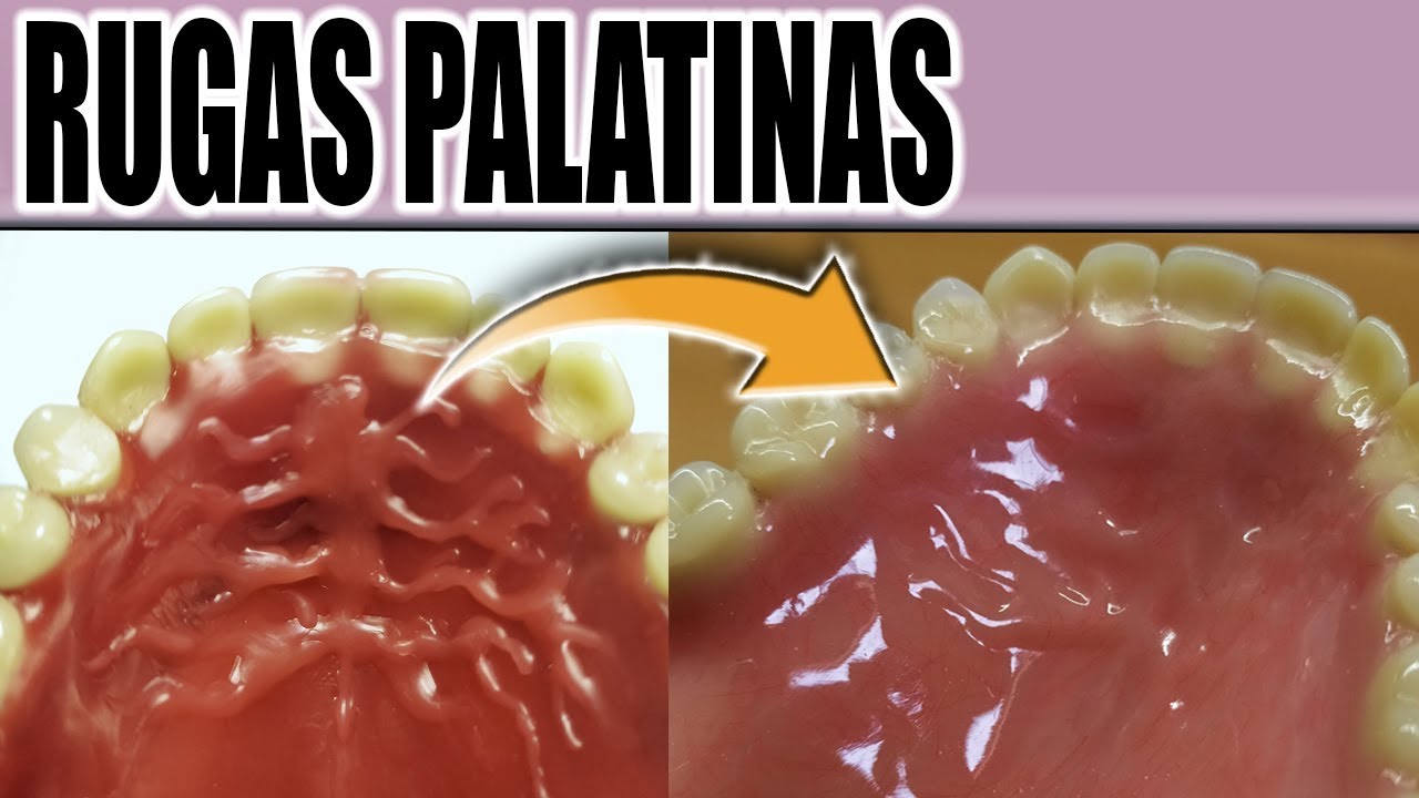 HACER RUGAS PALATINAS EN PRÓTESIS DENTAL PASO A PASO