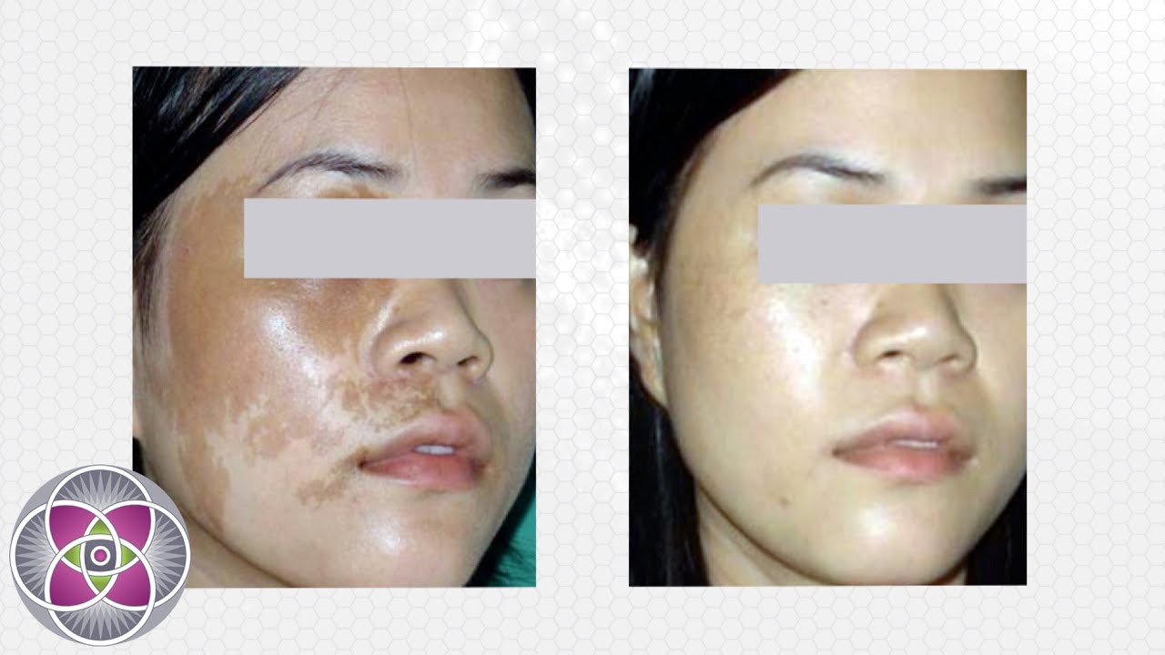 Laser Birthmark Removal Treatment - Does it Work?