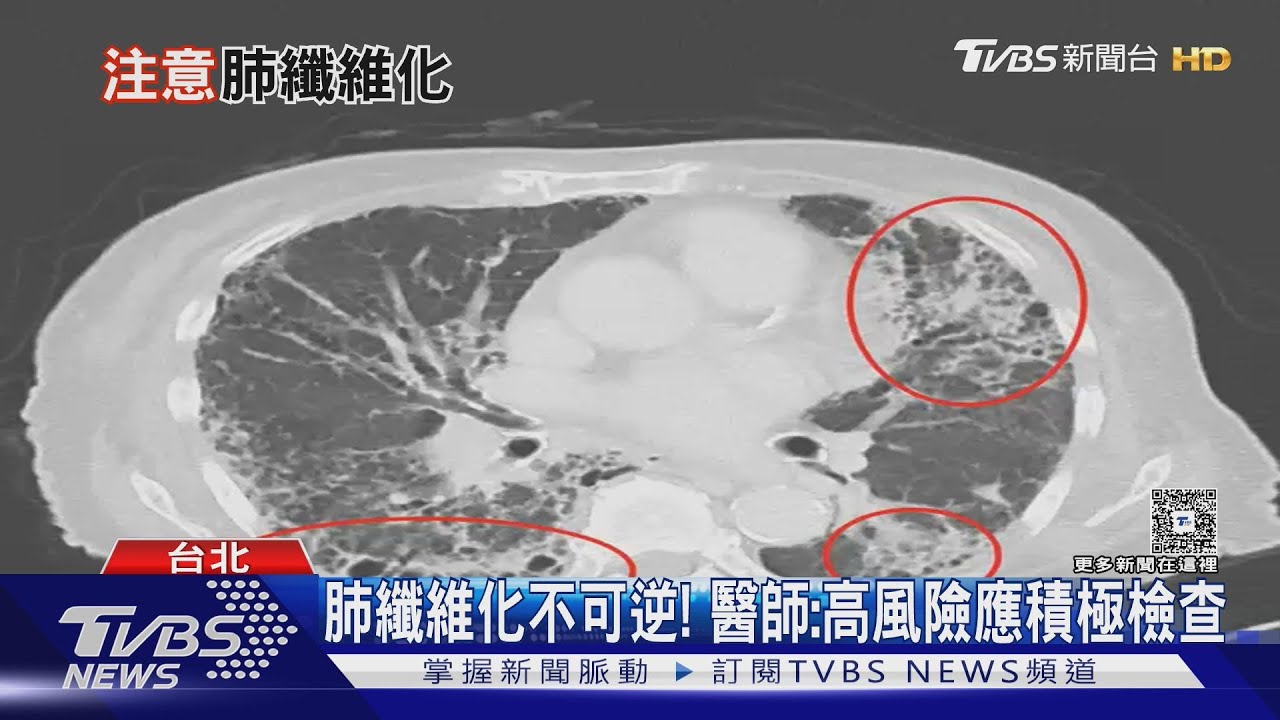 長期咳嗽＋運動就喘勿輕忽! 恐罹「菜瓜布肺」致死風險高!｜十點不一樣2026202@TVBSNEWS01