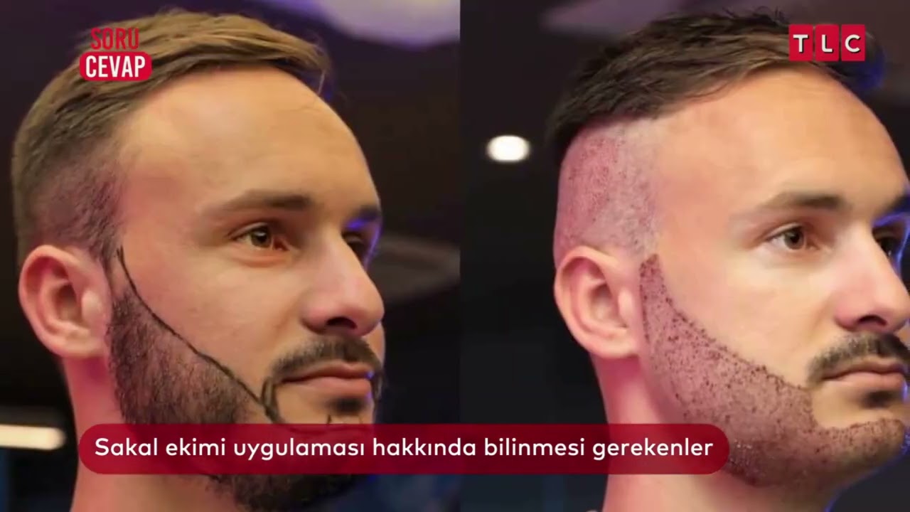 Köse Kalmaya Son! Sakal Ekimi Süreci ve Sonuçları