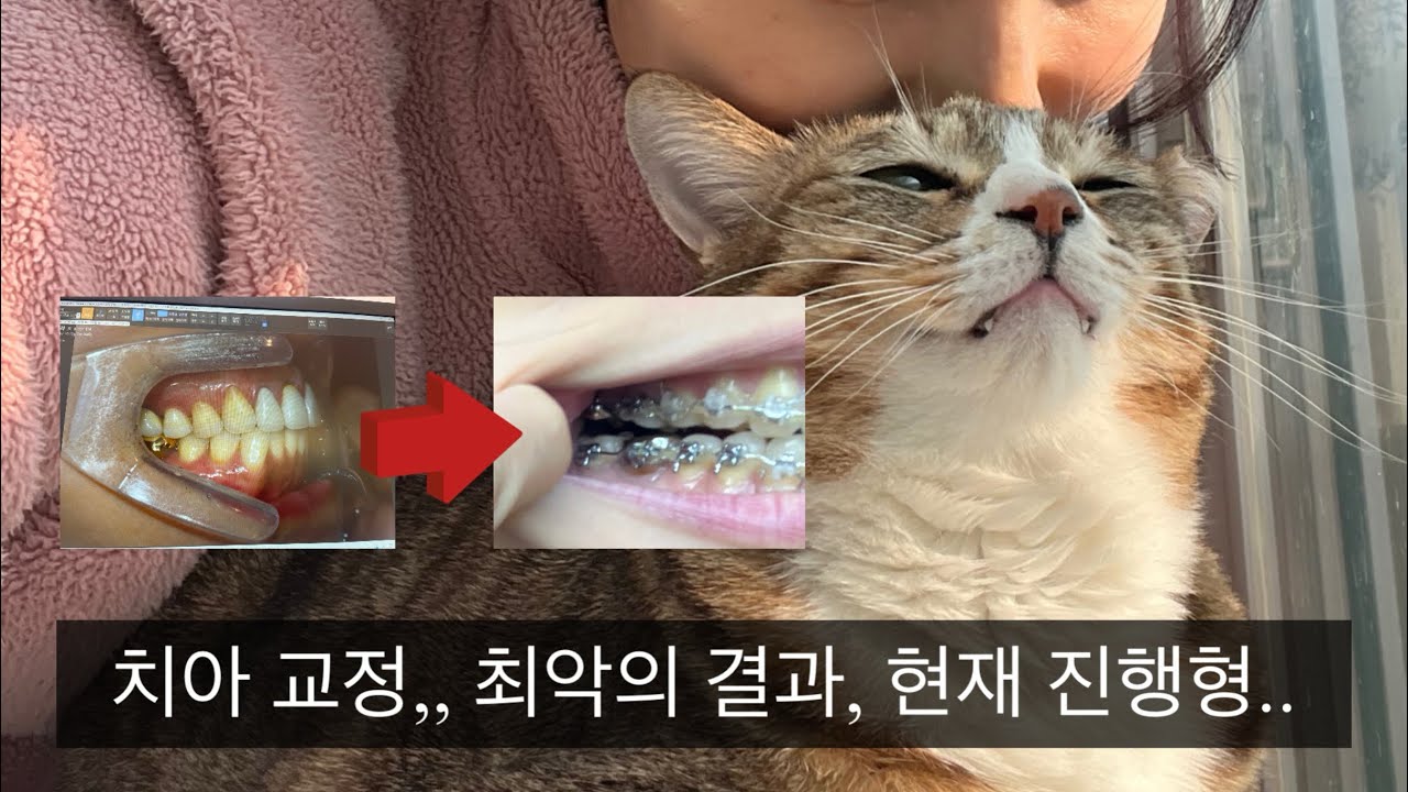 1. 저작 기능 상실. 내 인생을 망쳐버린 지옥같은 치아교정.. ￼구치부 개방교합