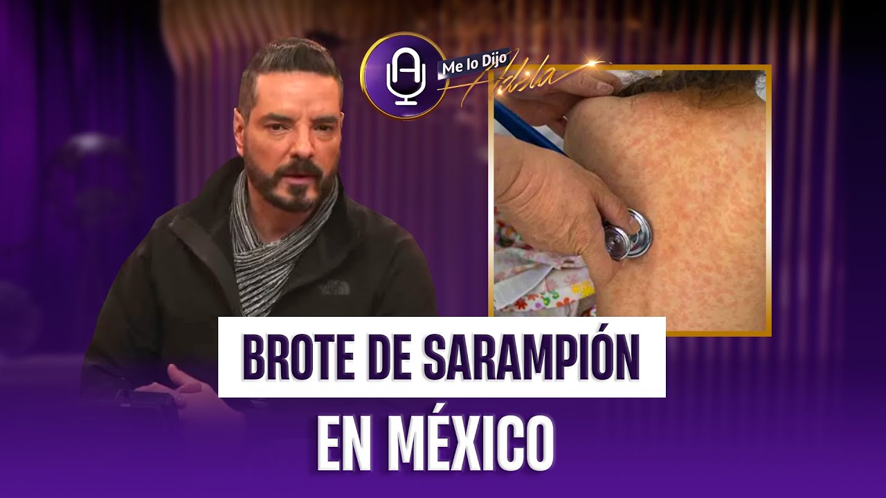 Sarampión EXPLOTA en México: la factura de “no vacunar” ya llegó | MLDA