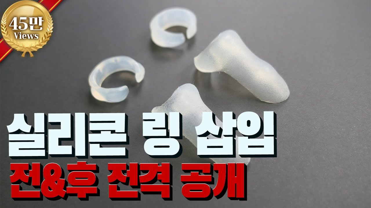3D 영상으로 보는 실리콘보형물(C링, T링, 티링)의 수술방법과 수술전후