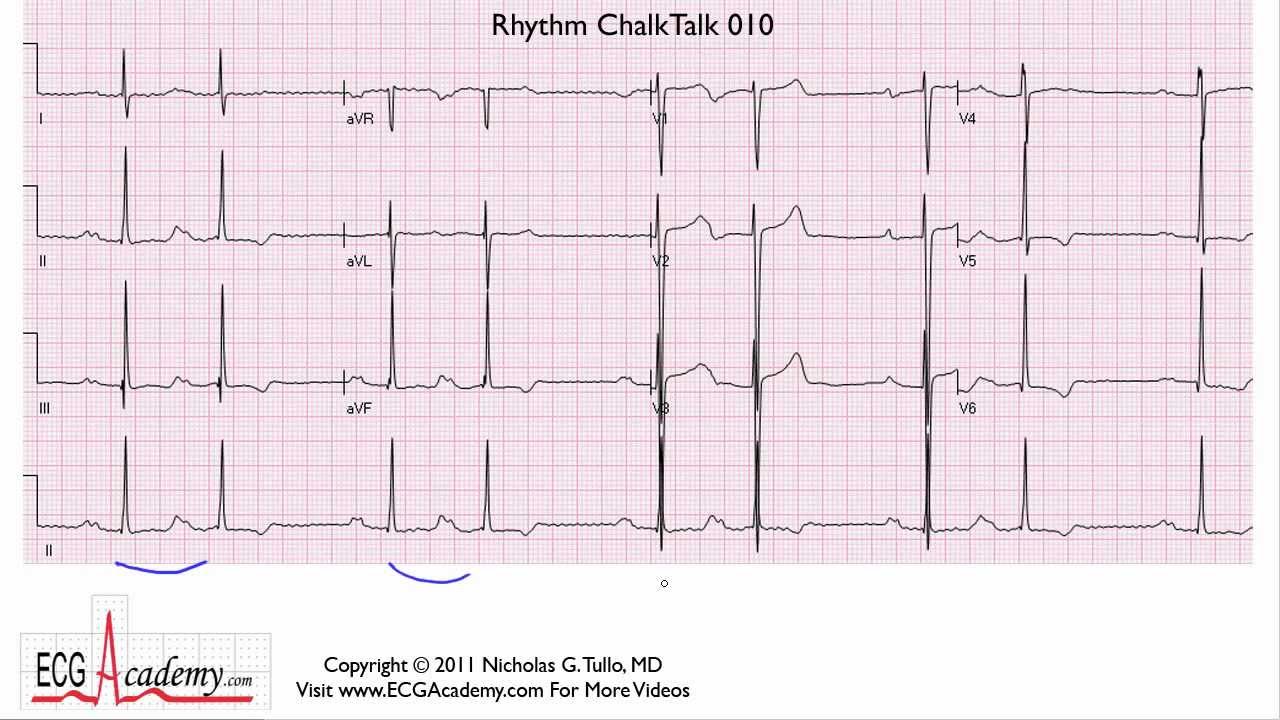 ECG Interpretation Tutorial - ChalkTalk 10 - Intermediate Level